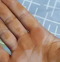 TV9 WHATSAPP İHBAR HATTINA GELEN İLGİNÇ FOTOĞRAF: 'SABAH UYANDIĞIMDA ELİM BU HALE GELDİ'