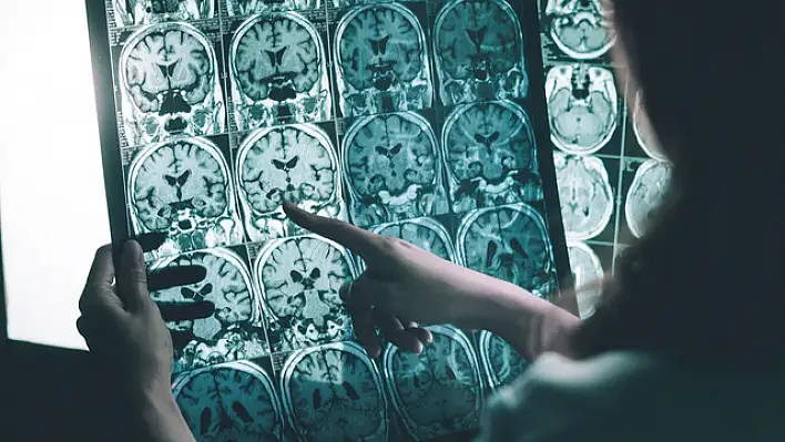 Alzheimer ilacının hastalığı yavaşlatıyor