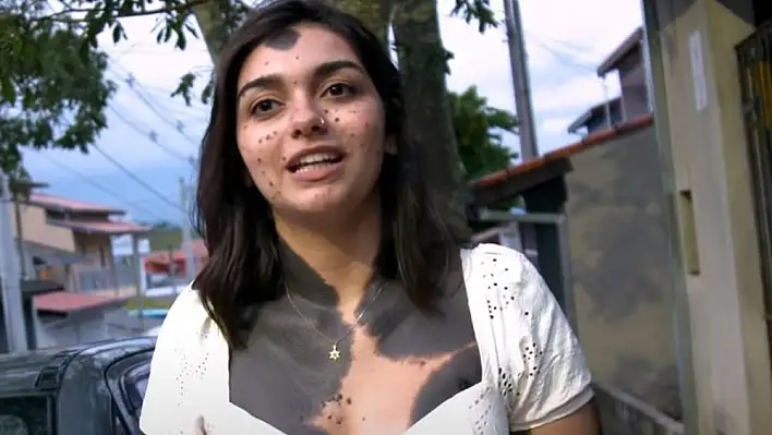 Beatriz, vücudunun neredeyse tamamını kaplayan bir doğum lekesiyle dünyaya geldi.