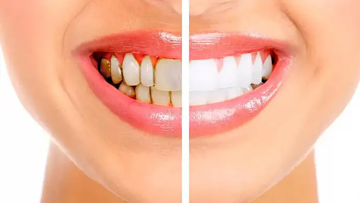 Diş temizliğinde nelere dikkat etmeliyiz?