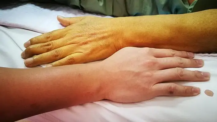 Sarılığın nedenleri nelerdir?