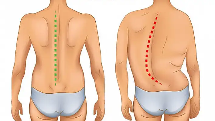Skolyoz Hastalarındaki Kronik Ağrı Uyku Kalitesini Düşürüyor
