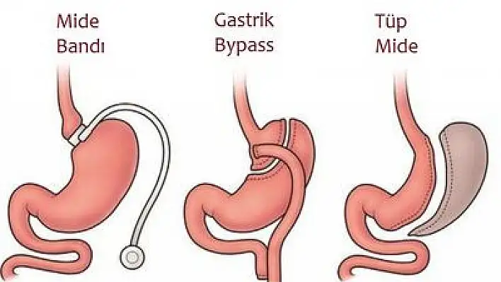 Tüp mide ameliyatıyla obezite tedavisi