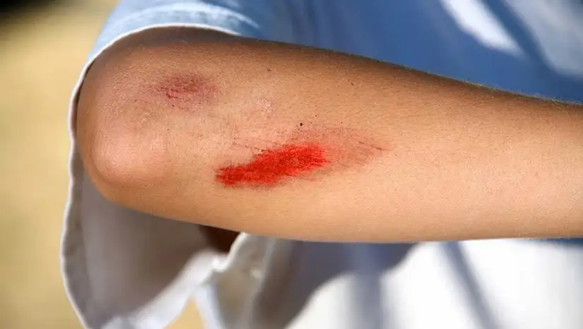 Yaraların Hızlı İyileşmesi İçin Uzmanlardan Öneriler